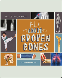 All About Broken Bones
